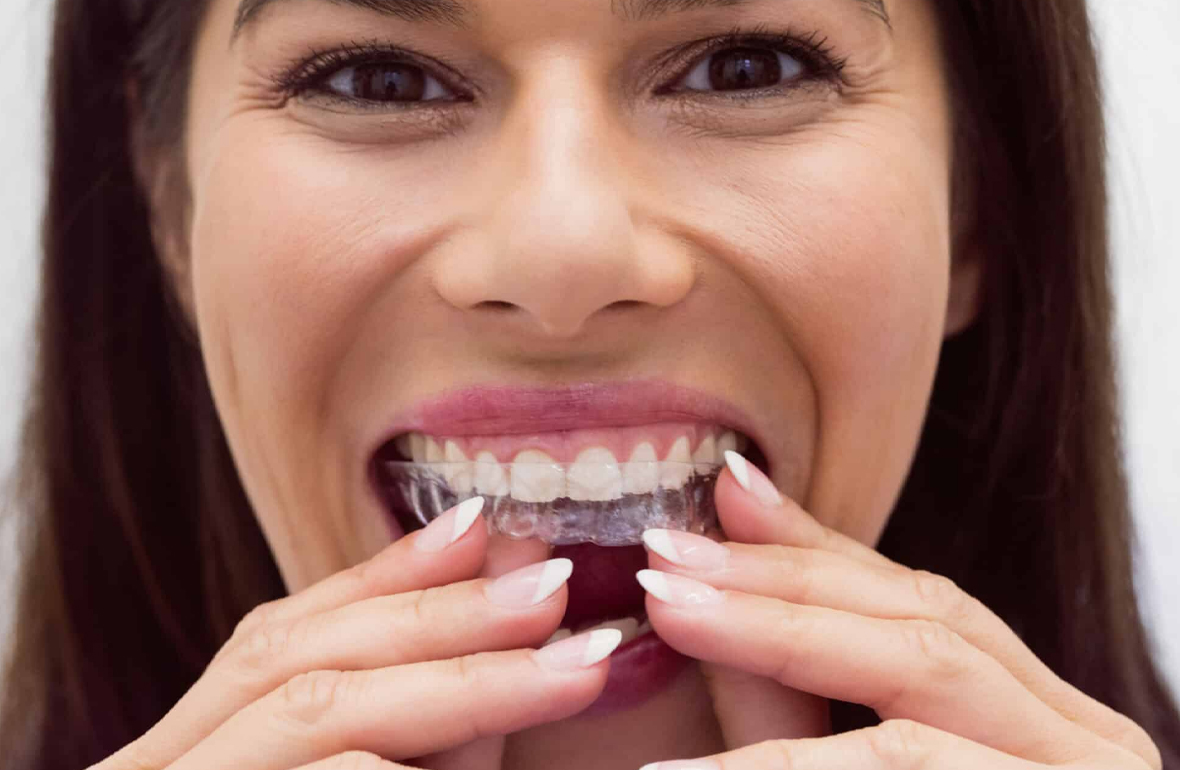 Why Invisalign is Better Than Braces A Clear Choice for a Confident Smile